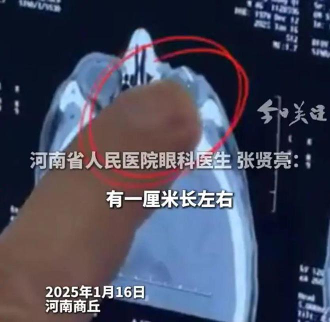 门上铁锈 钢丝意外飞溅眼中穿透眼角膜凯发k8国际娱乐首选男子拿钢丝球清理